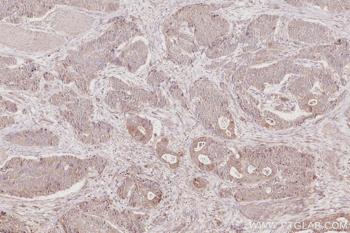 IHC staining of human stomach cancer using 27870-1-AP (same clone as 27870-1-PBS)