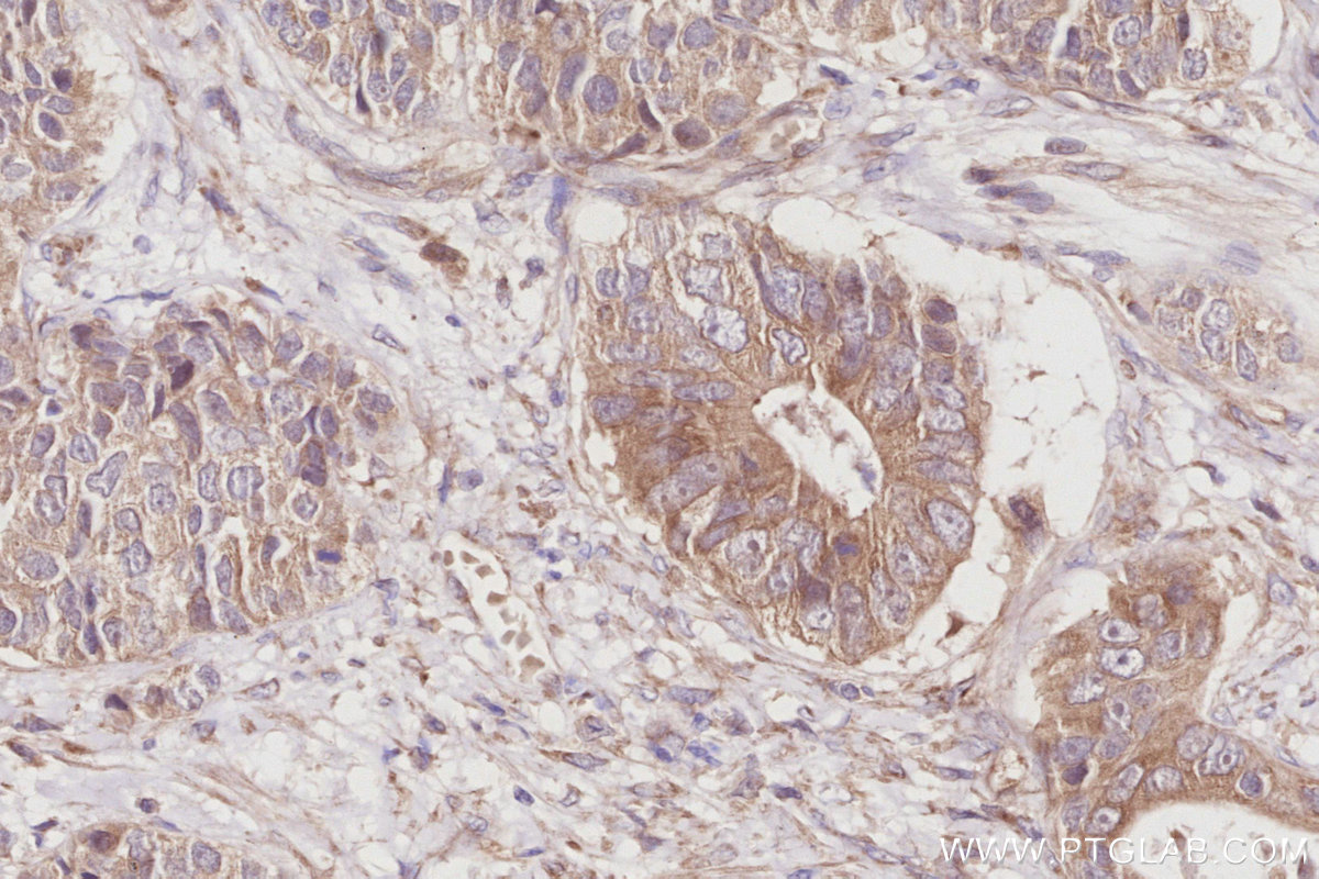 IHC staining of human stomach cancer using 27870-1-AP (same clone as 27870-1-PBS)