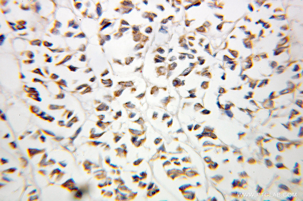 IHC staining of human breast cancer using 10671-1-AP