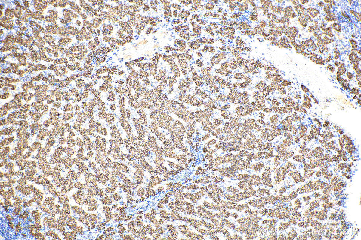 IHC staining of human liver cancer using 26470-1-AP