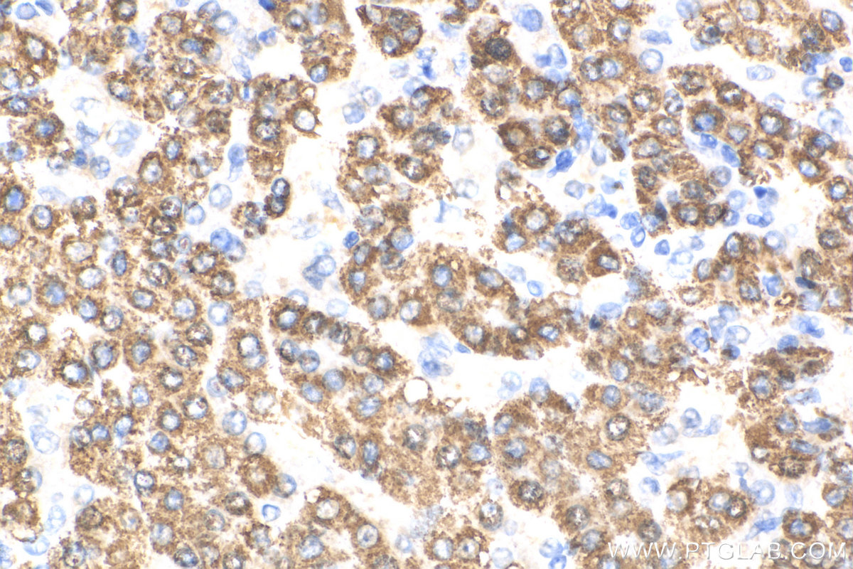 IHC staining of human liver cancer using 26470-1-AP