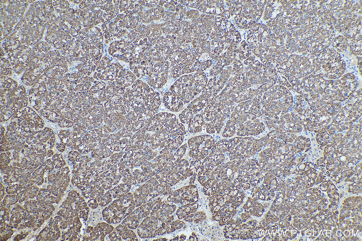 IHC staining of human liver cancer using 67553-1-Ig