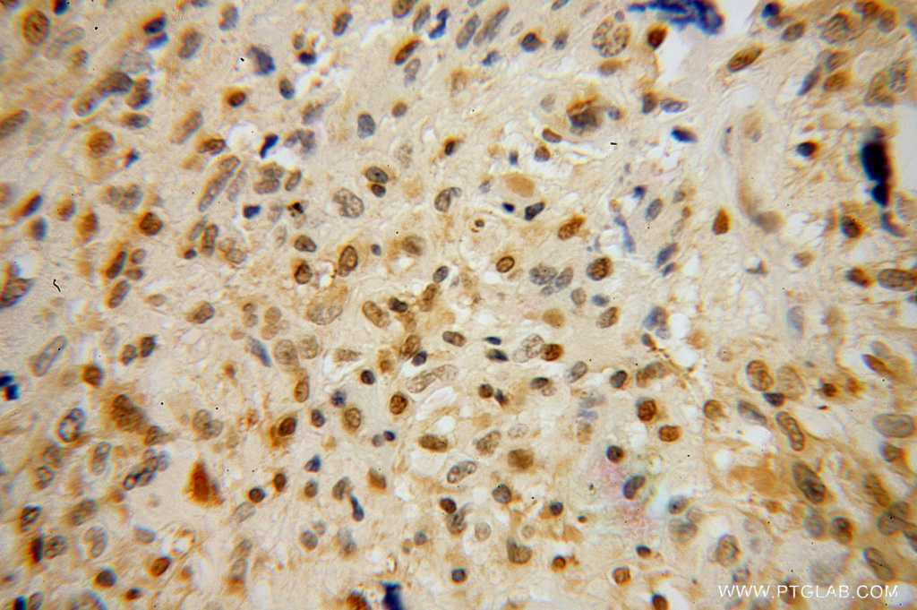IHC staining of human gliomas using 13497-1-AP