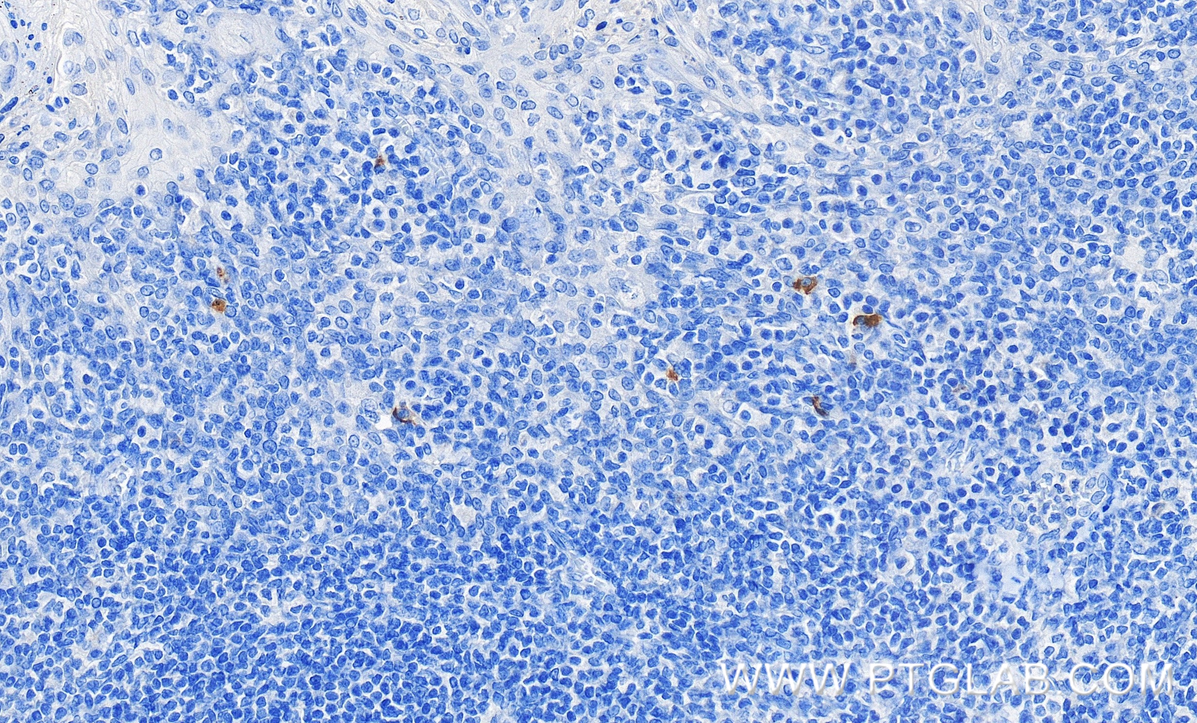 IHC staining of human tonsillitis using 82794-7-RR