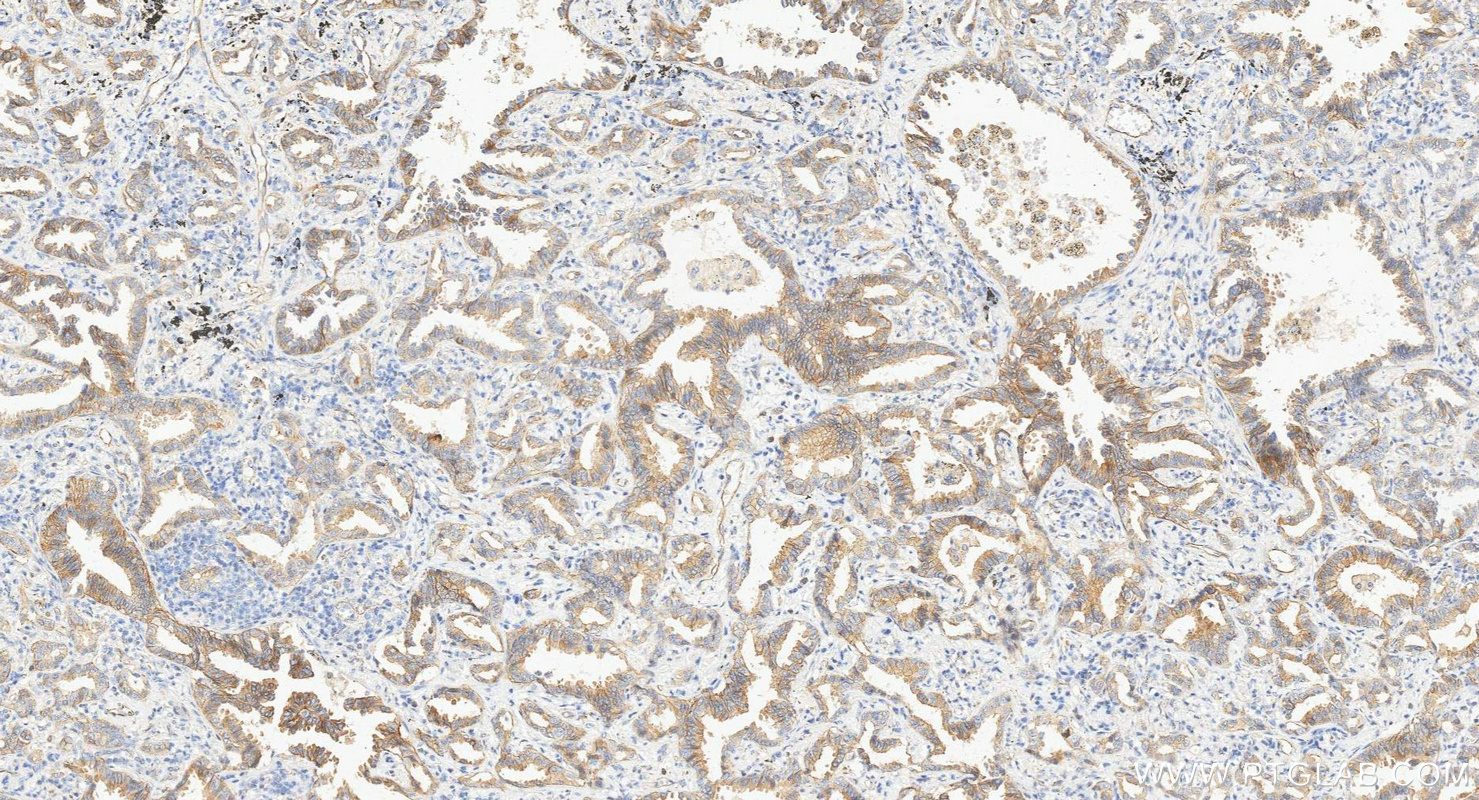 IHC staining of human lung cancer using 66378-1-Ig IHC staining of human lung cancer using 66378-1-Ig