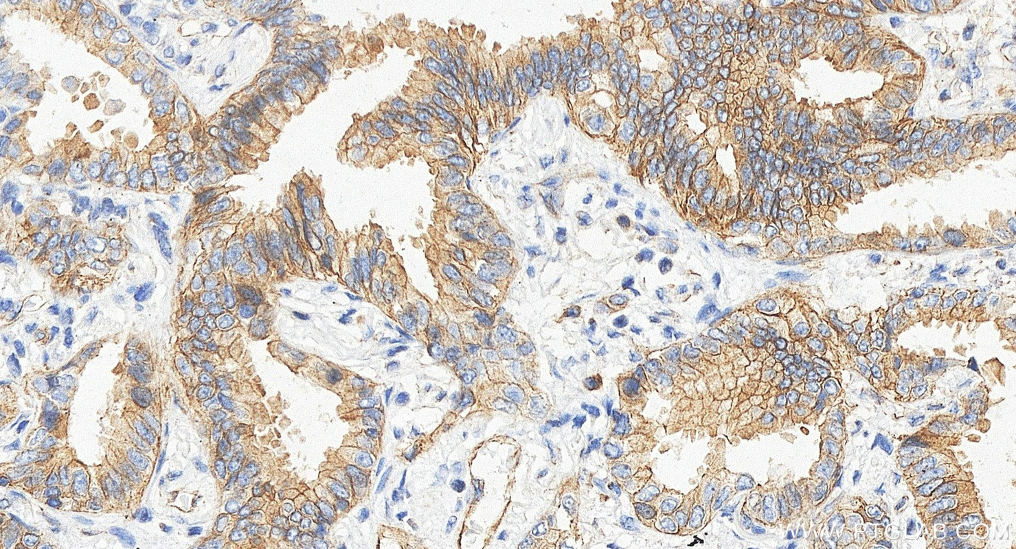 IHC staining of human lung cancer using 66378-1-Ig IHC staining of human lung cancer using 66378-1-Ig