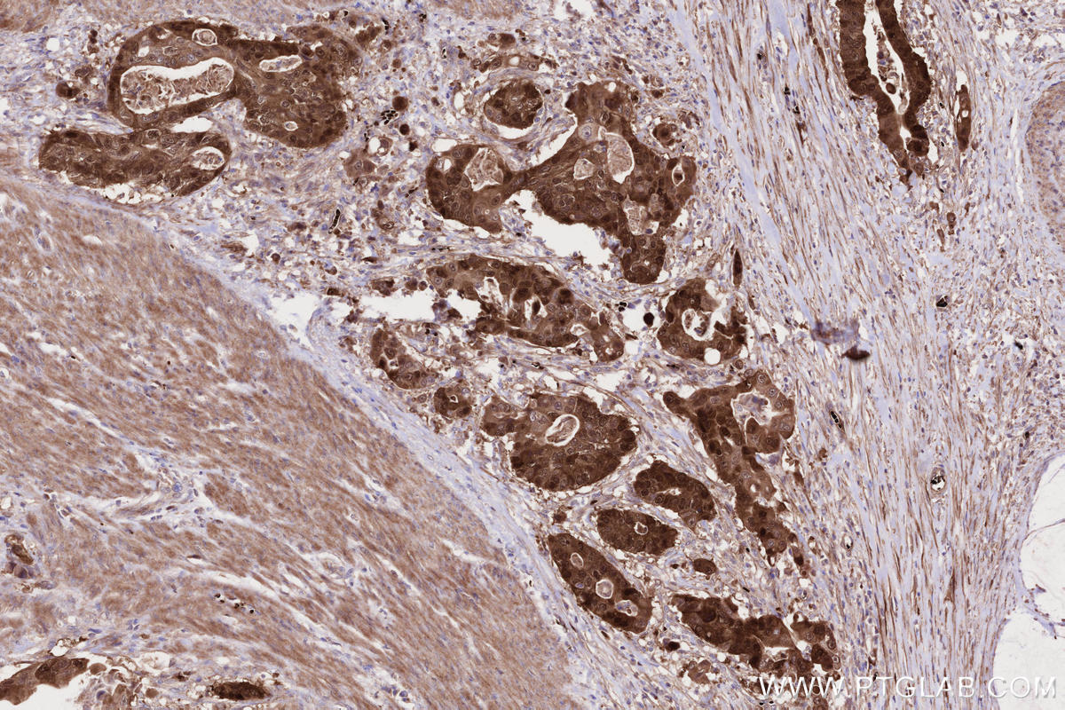 IHC staining of human stomach cancer using 30519-1-AP