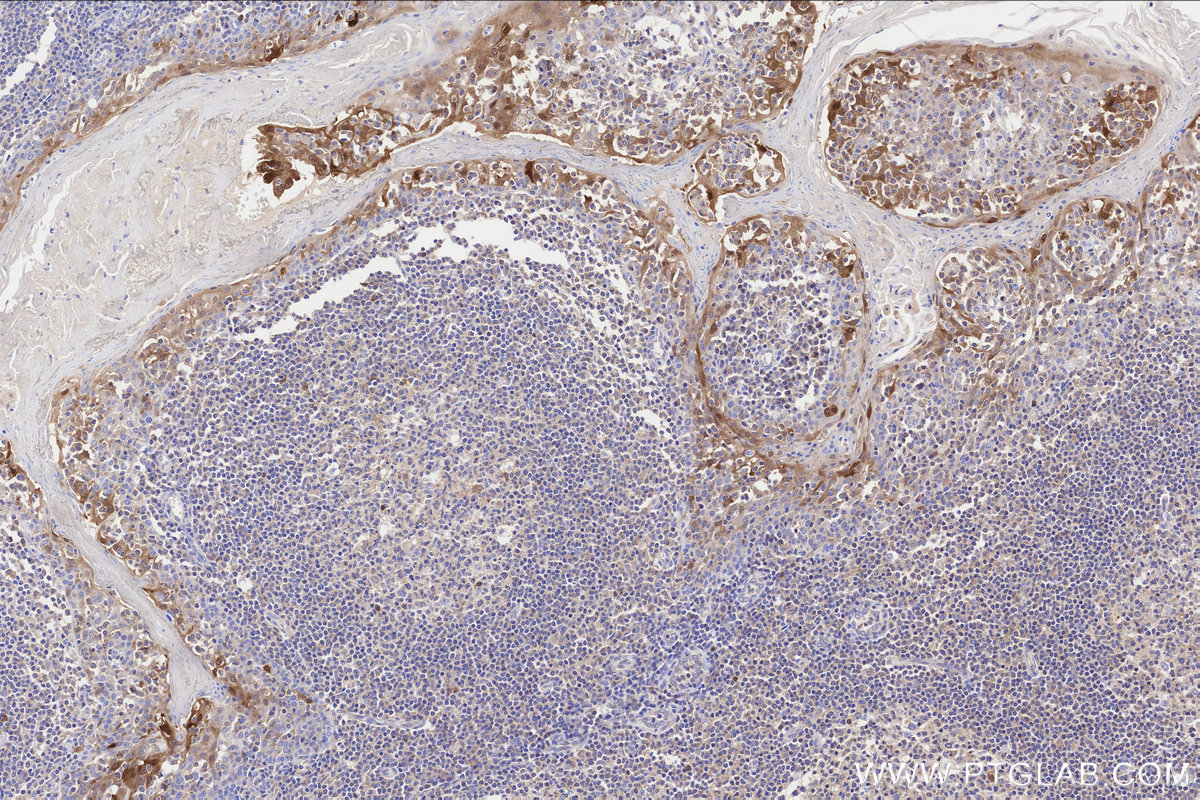 IHC staining of human tonsillitis using 60626-1-Ig IHC staining of human tonsillitis using 60626-1-Ig