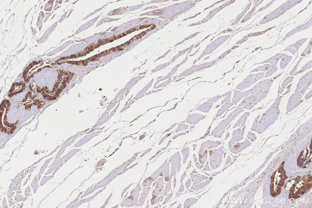 IHC staining of human rectal cancer using 60626-1-Ig IHC staining of human rectal cancer using 60626-1-Ig