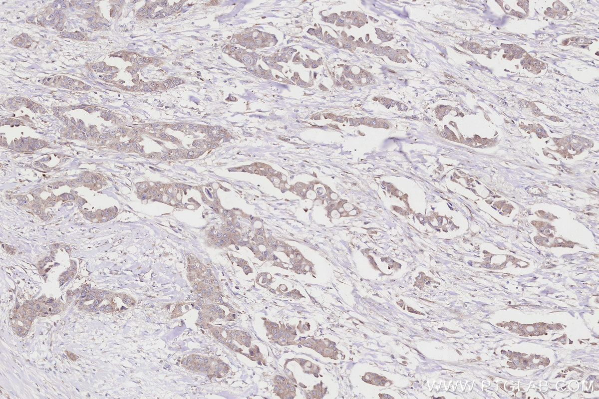 IHC staining of Human Breast Cancer(Her2+;ER-;PR-) using 60626-1-Ig IHC staining of Human Breast Cancer(Her2+;ER-;PR-) using 60626-1-Ig