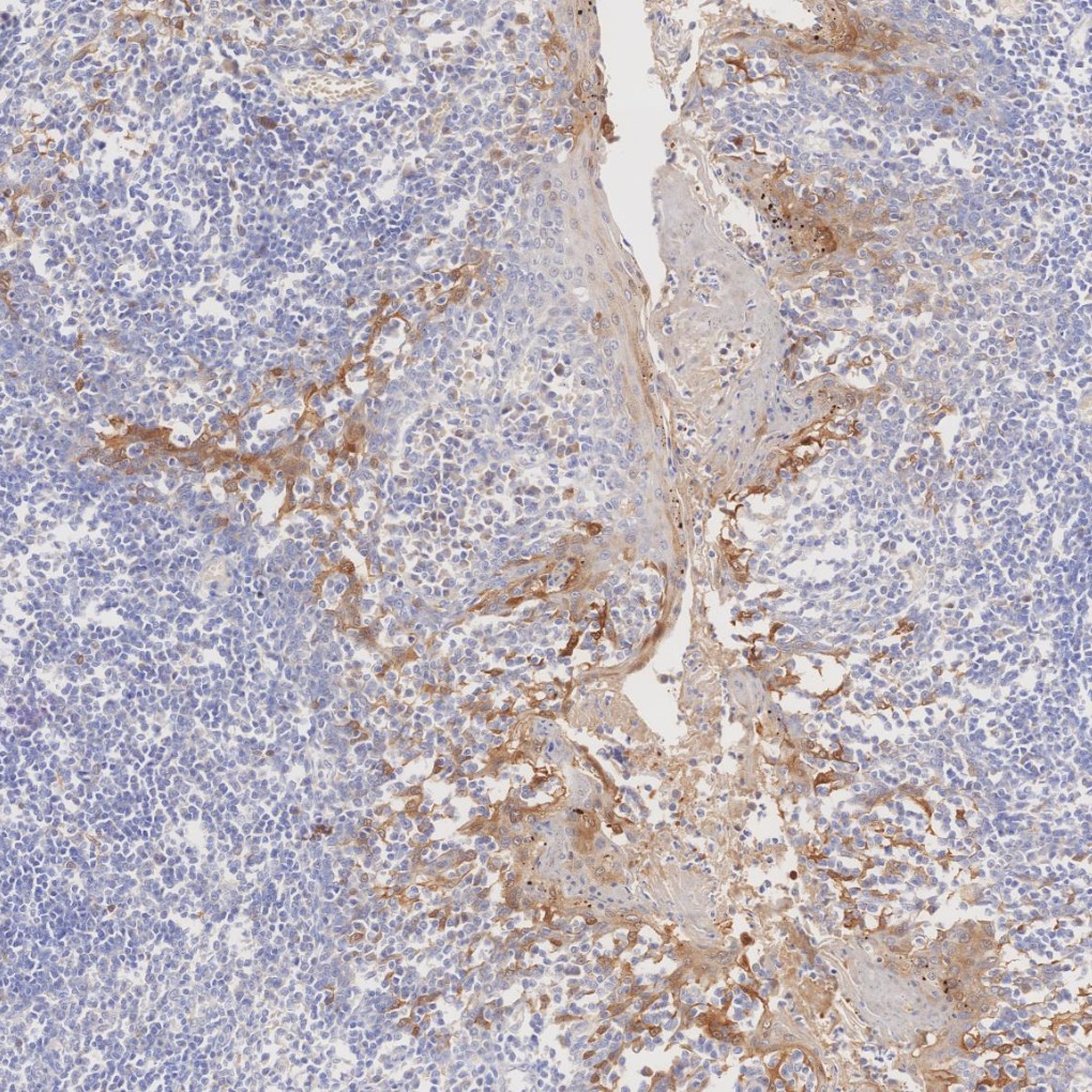 IHC staining of human tonsillitis using 60626-1-Ig IHC staining of human tonsillitis using 60626-1-Ig