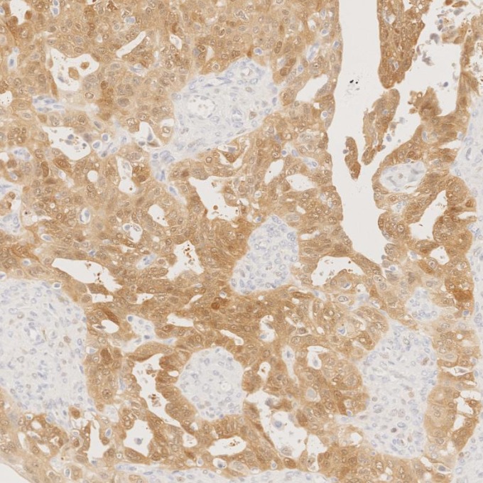 IHC staining of human ovary cancer using 60626-1-Ig IHC staining of human ovary cancer using 60626-1-Ig