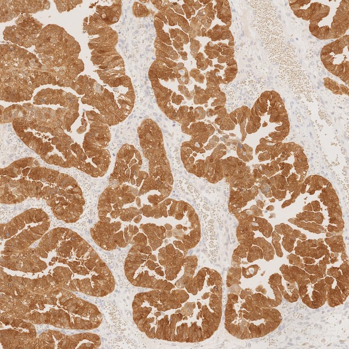 IHC staining of human ovary cancer using 60626-1-Ig IHC staining of human ovary cancer using 60626-1-Ig