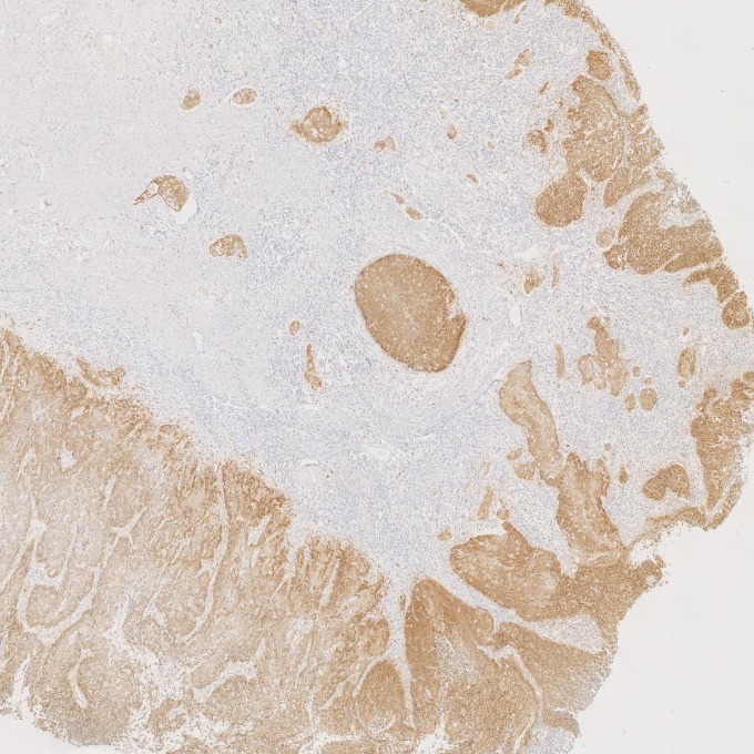 IHC staining of human cervical cancer using 60626-1-Ig IHC staining of human cervical cancer using 60626-1-Ig