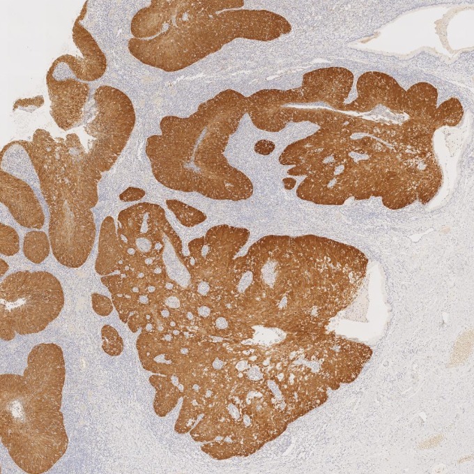 IHC staining of human cervical cancer using 60626-1-Ig IHC staining of human cervical cancer using 60626-1-Ig