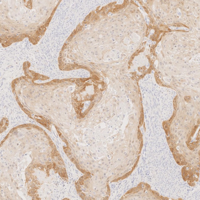 IHC staining of human cervical cancer using 60626-1-Ig IHC staining of human cervical cancer using 60626-1-Ig