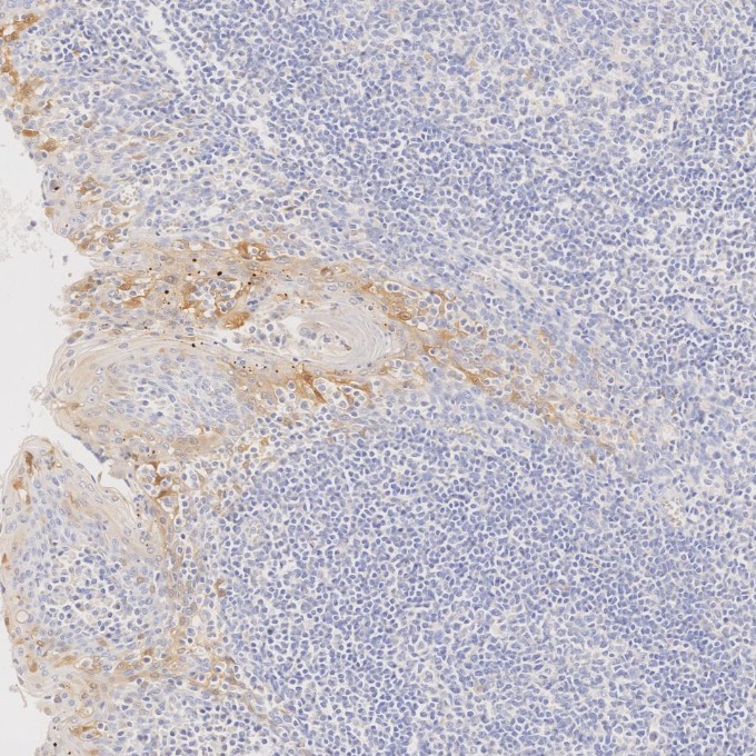 IHC staining of human tonsillitis using 60626-1-Ig IHC staining of human tonsillitis using 60626-1-Ig