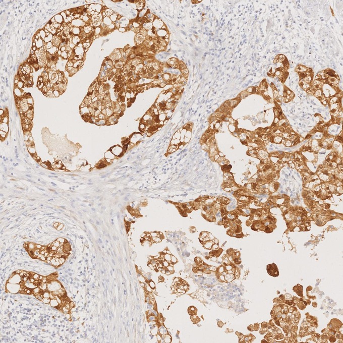 IHC staining of human ovary cancer using 60626-1-Ig IHC staining of human ovary cancer using 60626-1-Ig
