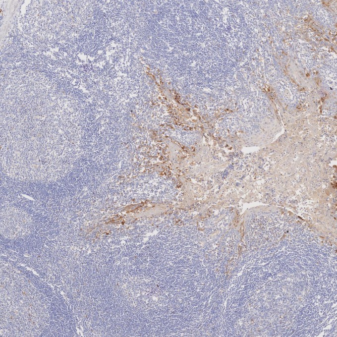 IHC staining of human tonsillitis using 60626-1-Ig IHC staining of human tonsillitis using 60626-1-Ig