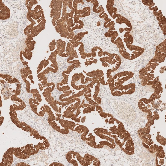 IHC staining of human ovary cancer using 60626-1-Ig IHC staining of human ovary cancer using 60626-1-Ig