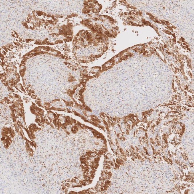 IHC staining of human ovary cancer using 60626-1-Ig IHC staining of human ovary cancer using 60626-1-Ig
