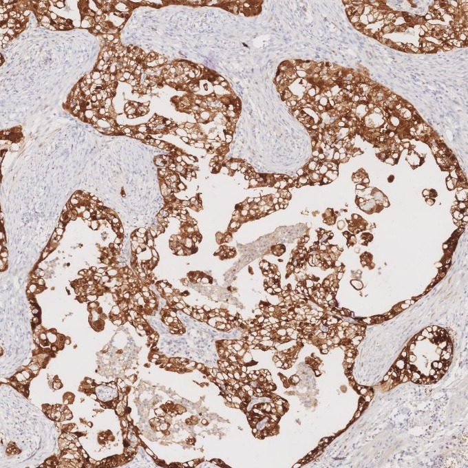 IHC staining of human ovary cancer using 60626-1-Ig IHC staining of human ovary cancer using 60626-1-Ig