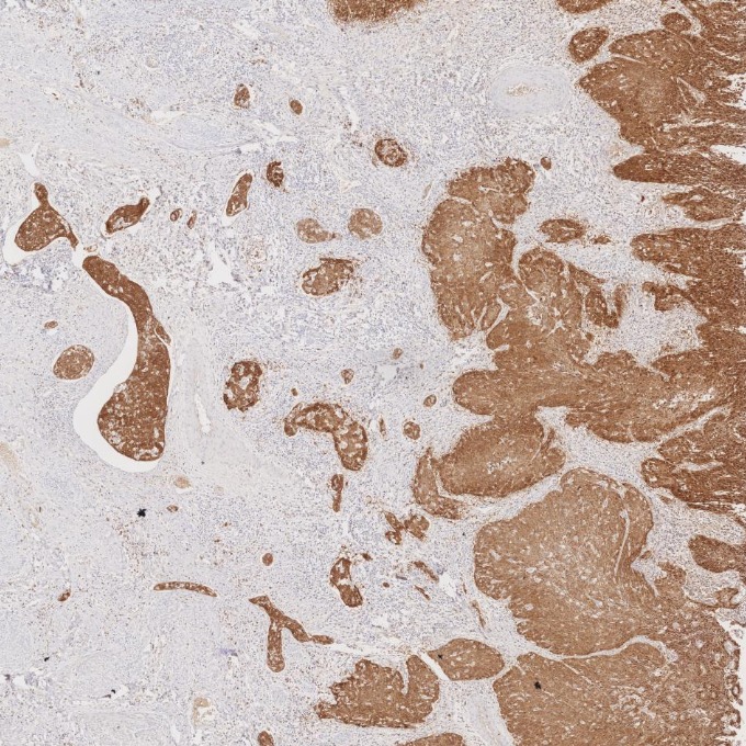 IHC staining of human cervical cancer using 60626-1-Ig IHC staining of human cervical cancer using 60626-1-Ig