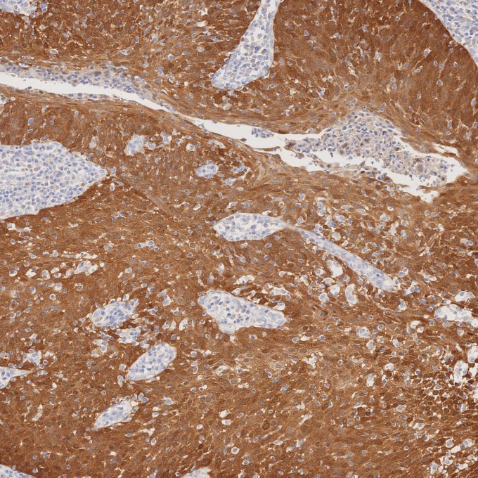 IHC staining of human cervical cancer using 60626-1-Ig IHC staining of human cervical cancer using 60626-1-Ig