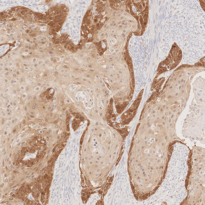 IHC staining of human cervical cancer using 60626-1-Ig IHC staining of human cervical cancer using 60626-1-Ig