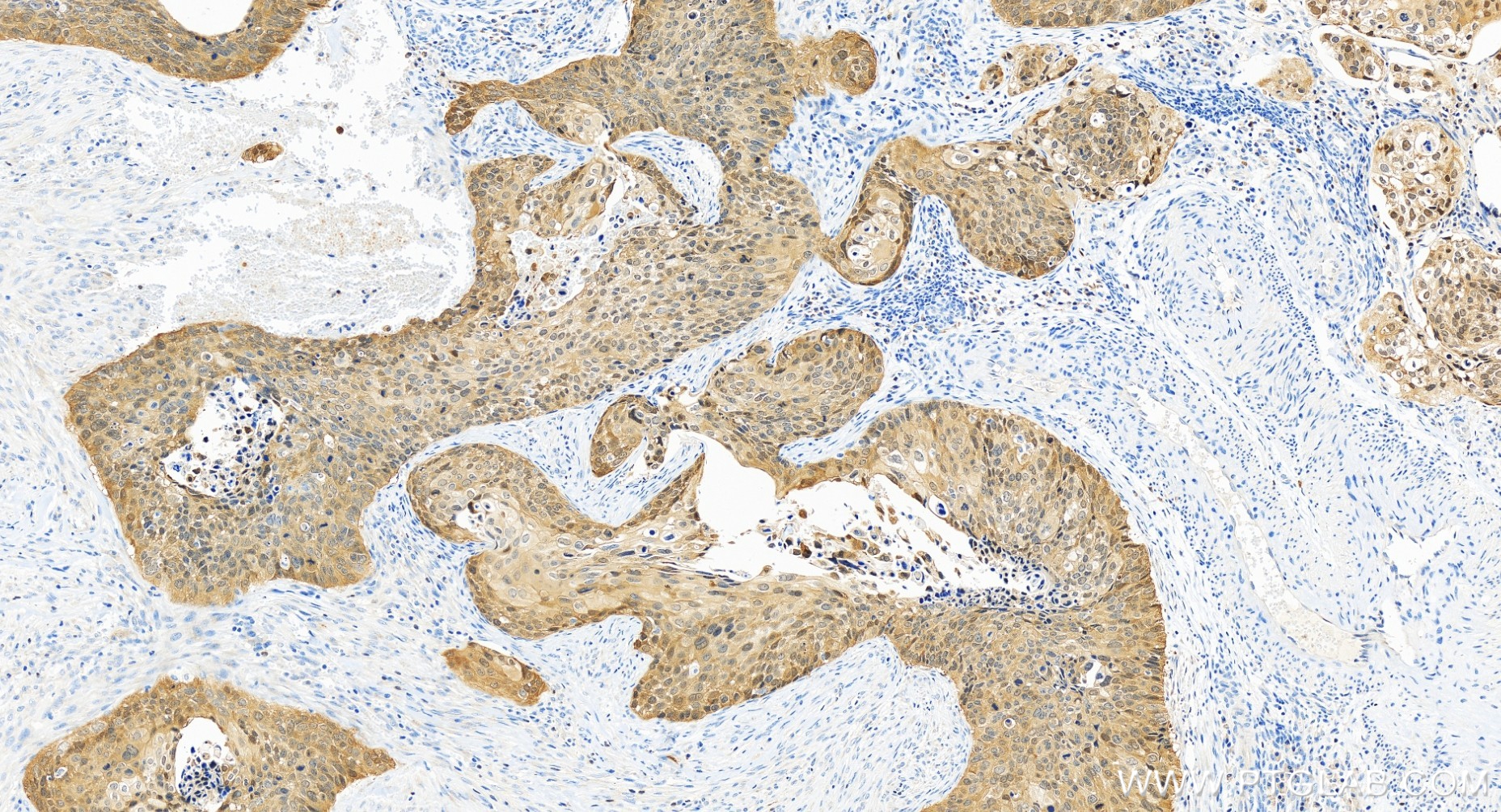 Immunohistochemical analysis of paraffin-embedded human cervical cancer tissue slide using 81373-10-RR (P16-INK4A antibody) at dilution of 1:500 (under 20x lens). Heat mediated antigen retrieval with Tris-EDTA buffer (pH 9.0). IHC staining of human cervical cancer using 81373-10-RR