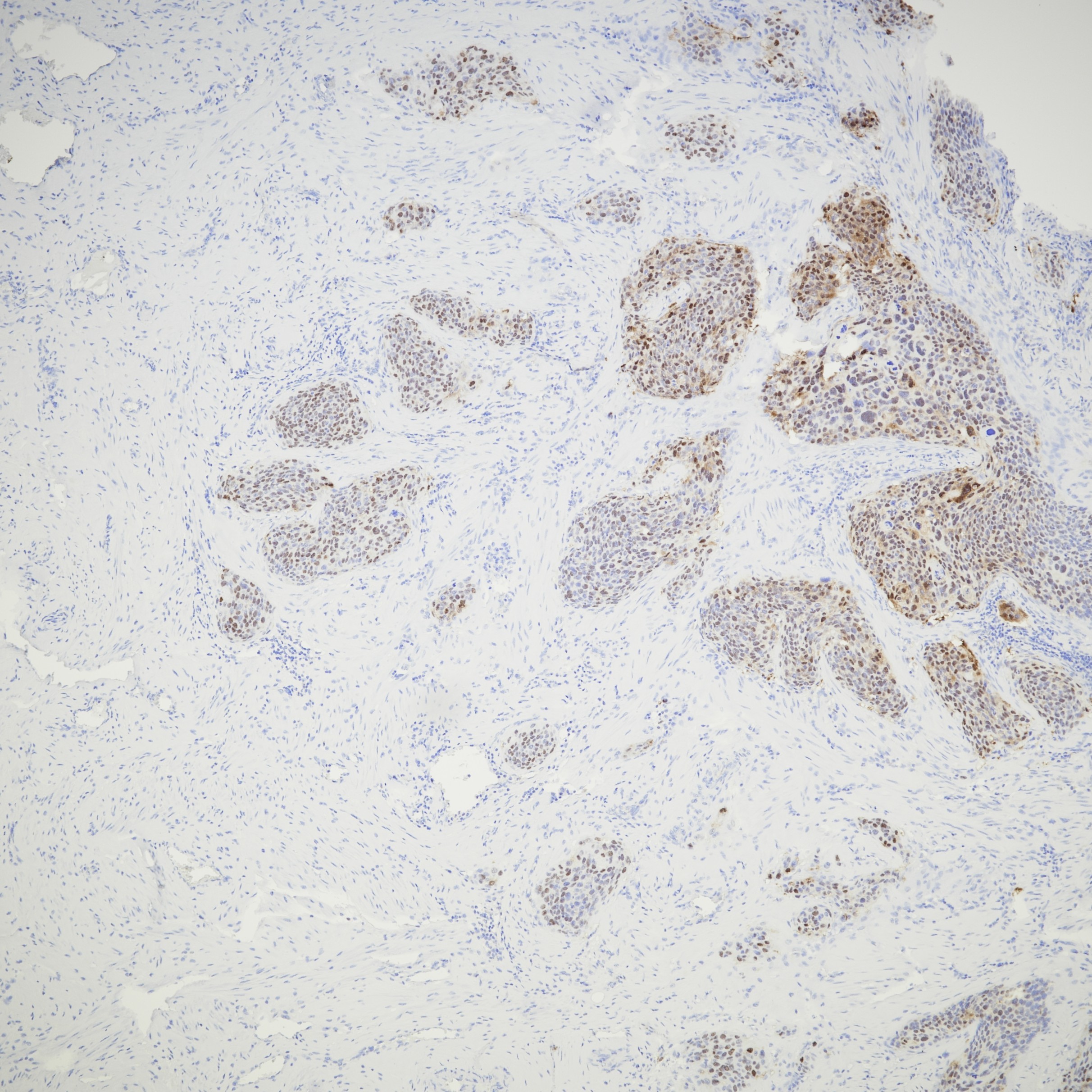 IHC staining of human cervical cancer using 81373-8-RR IHC staining of human cervical cancer using 81373-8-RR