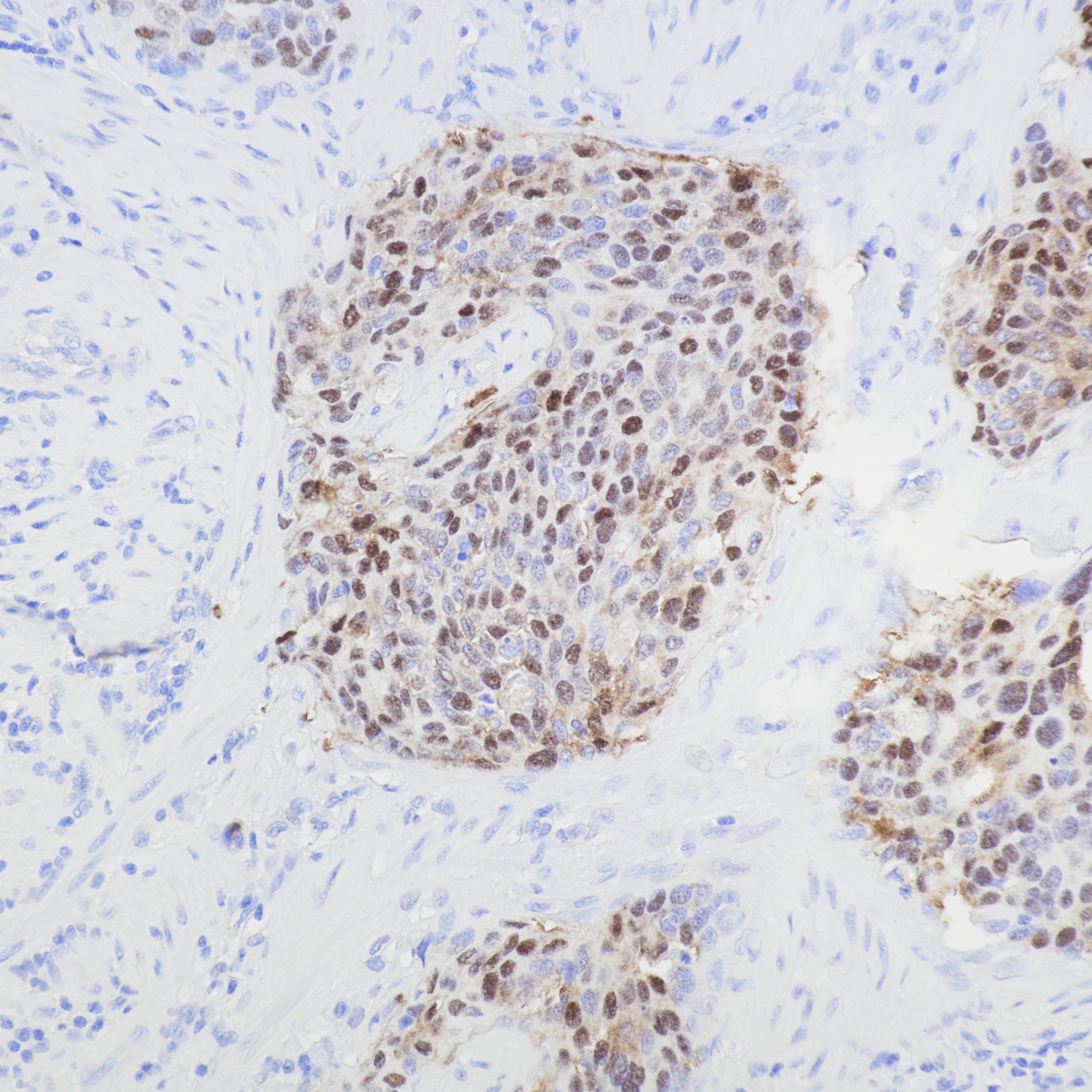IHC staining of human cervical cancer using 81373-8-RR IHC staining of human cervical cancer using 81373-8-RR