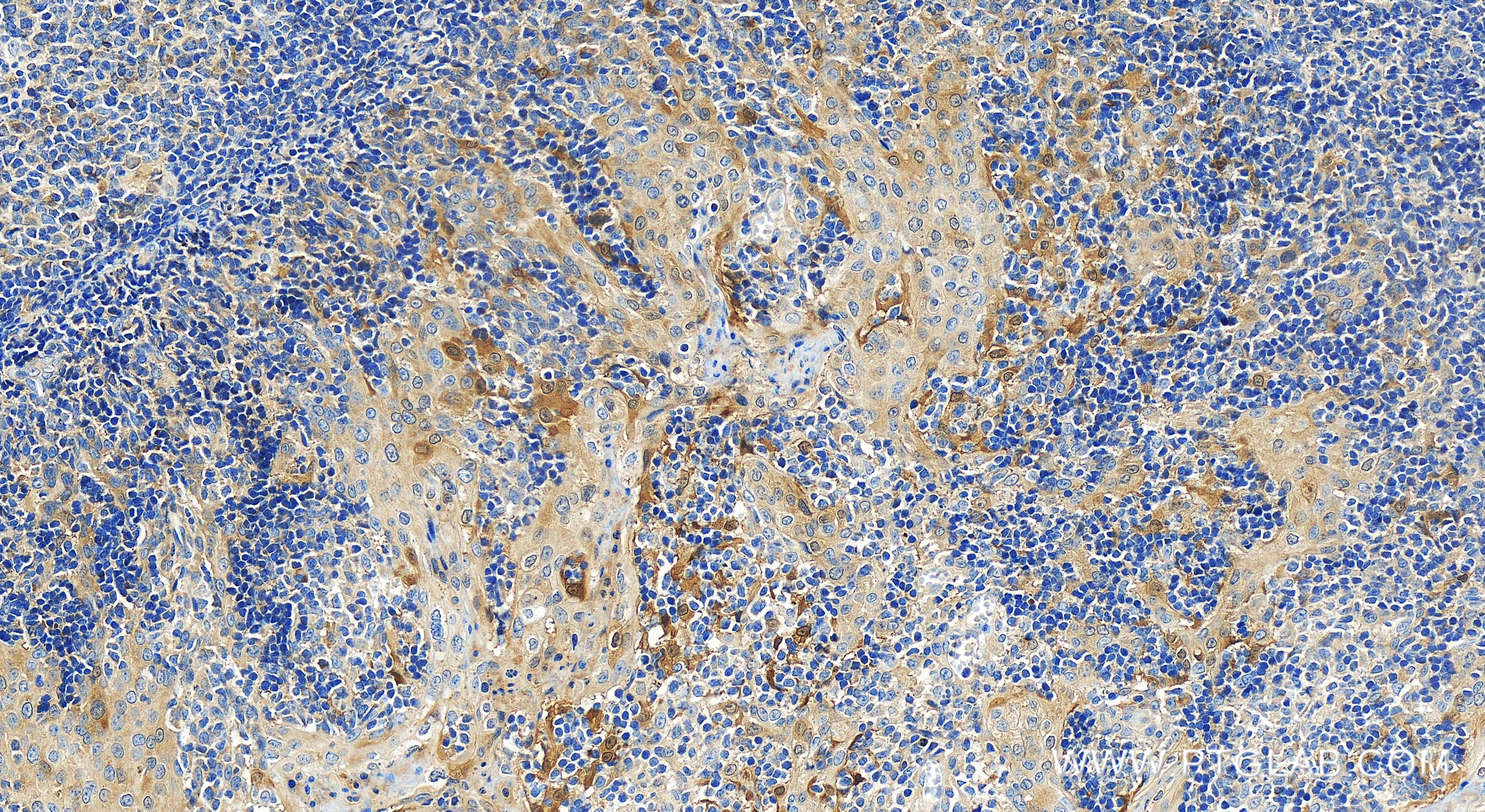 IHC staining of human tonsillitis using 81373-8-RR (same clone as 81373-8-PBS)