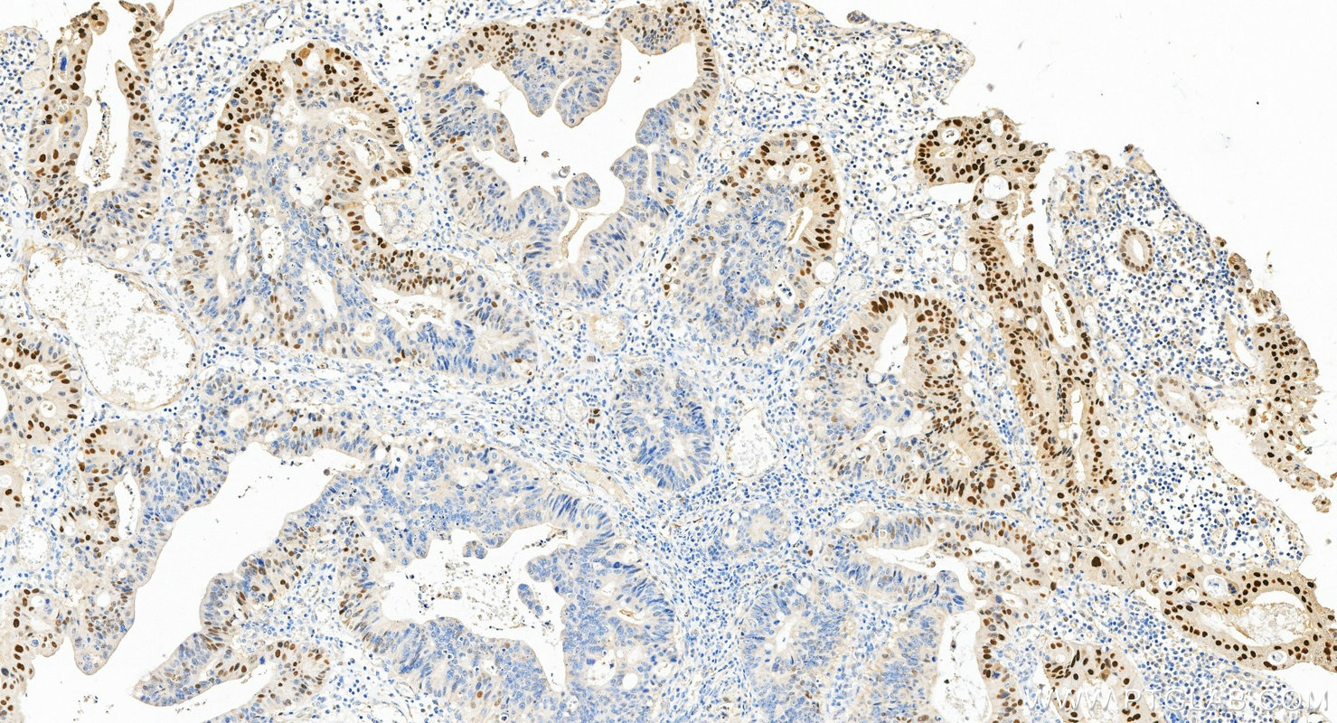 IHC staining of human colon cancer using 10355-1-AP