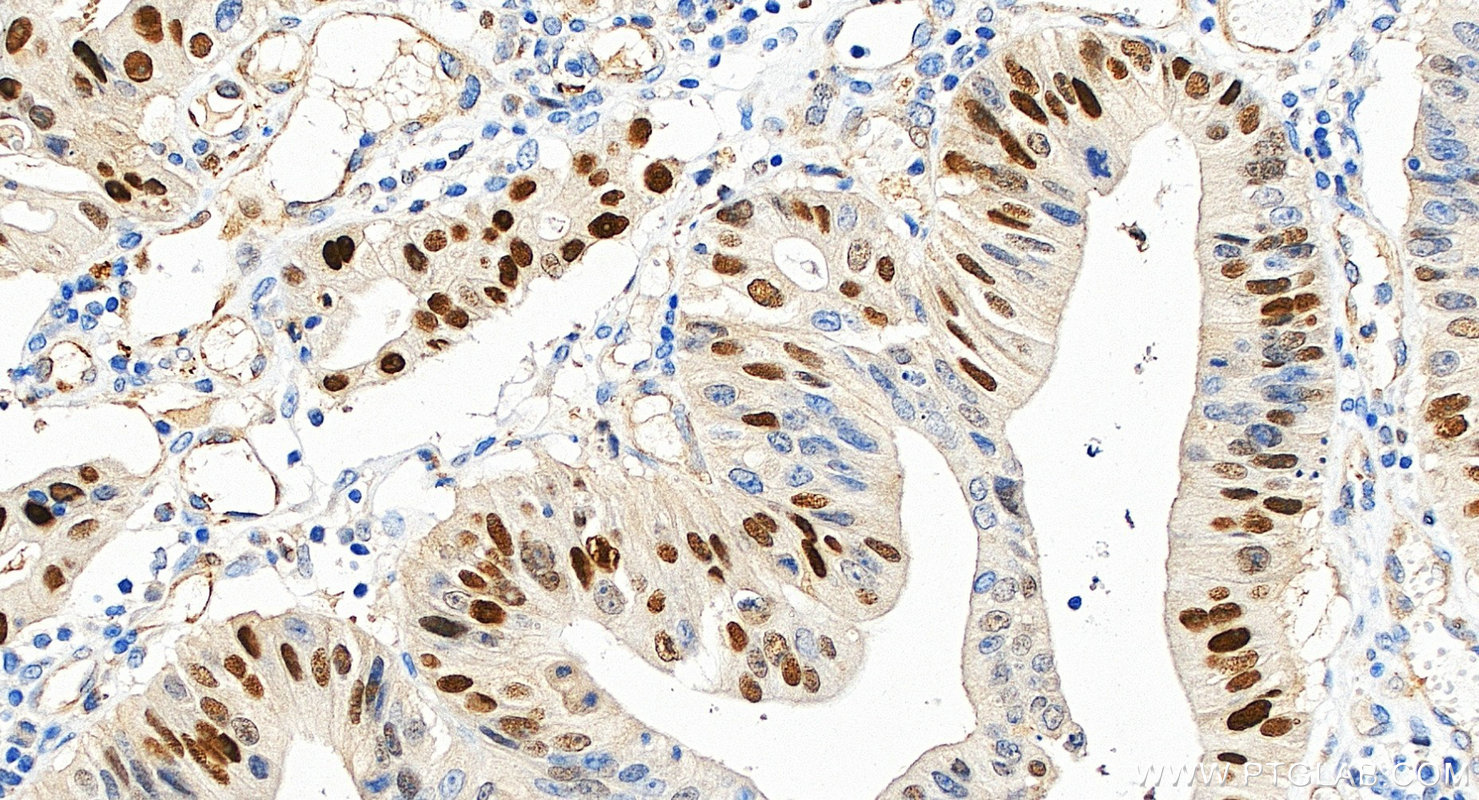IHC staining of human colon cancer using 10355-1-AP