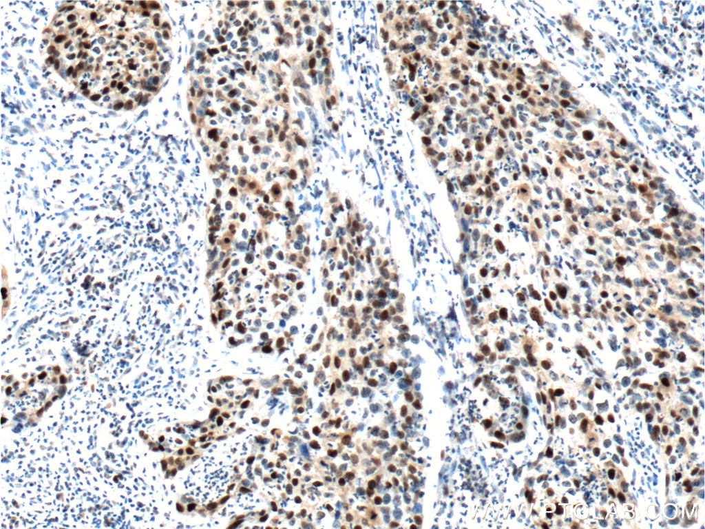 IHC staining of human cervical cancer using 10355-1-AP
