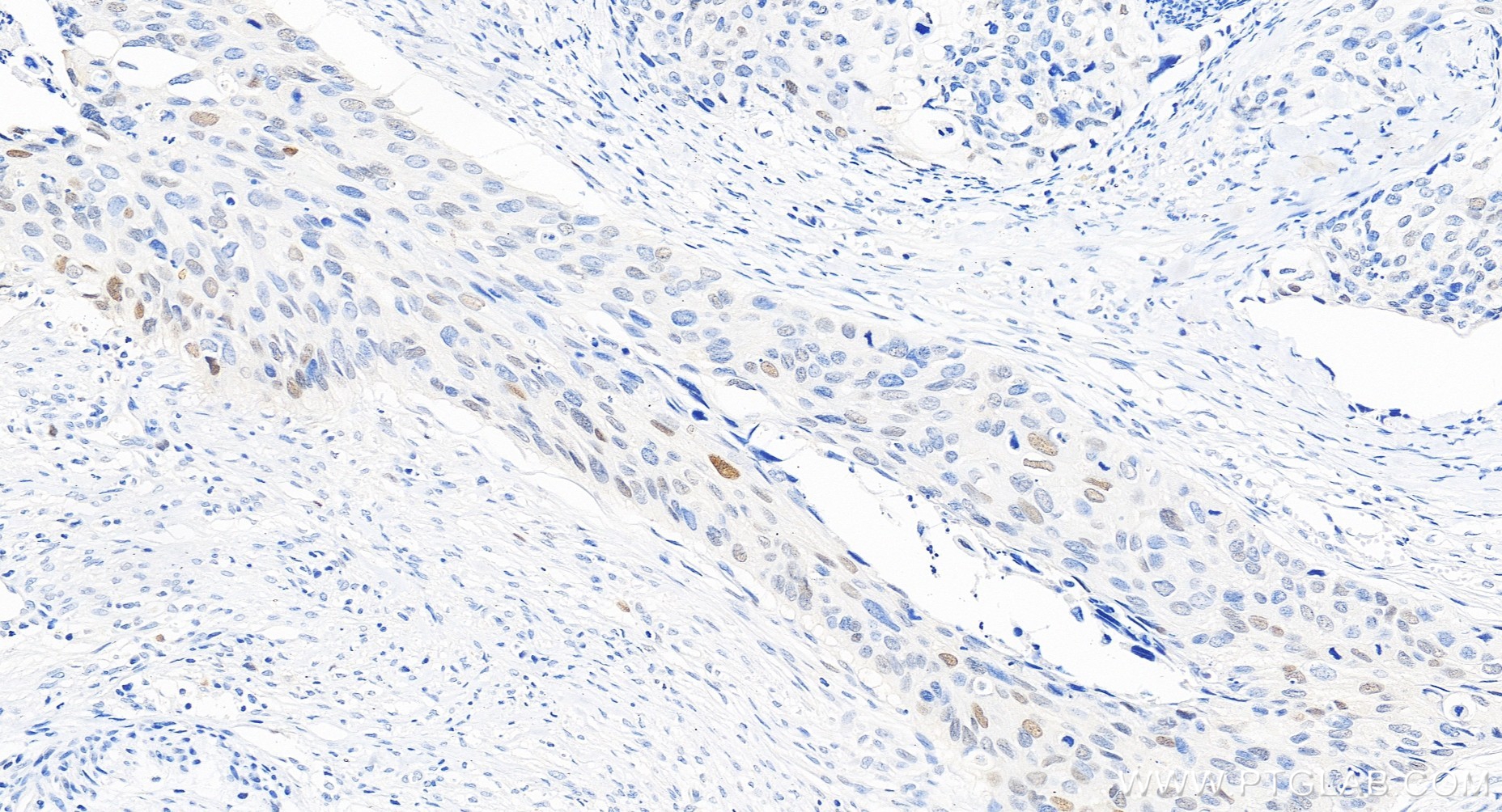 Immunohistochemical analysis of paraffin-embedded human cervical cancer tissue slide using 82669-2-RR (P21 antibody) at dilution of 1:400 (under 20x lens). Heat mediated antigen retrieval with Tris-EDTA buffer (pH 9.0). IHC staining of human cervical cancer using 82669-2-RR