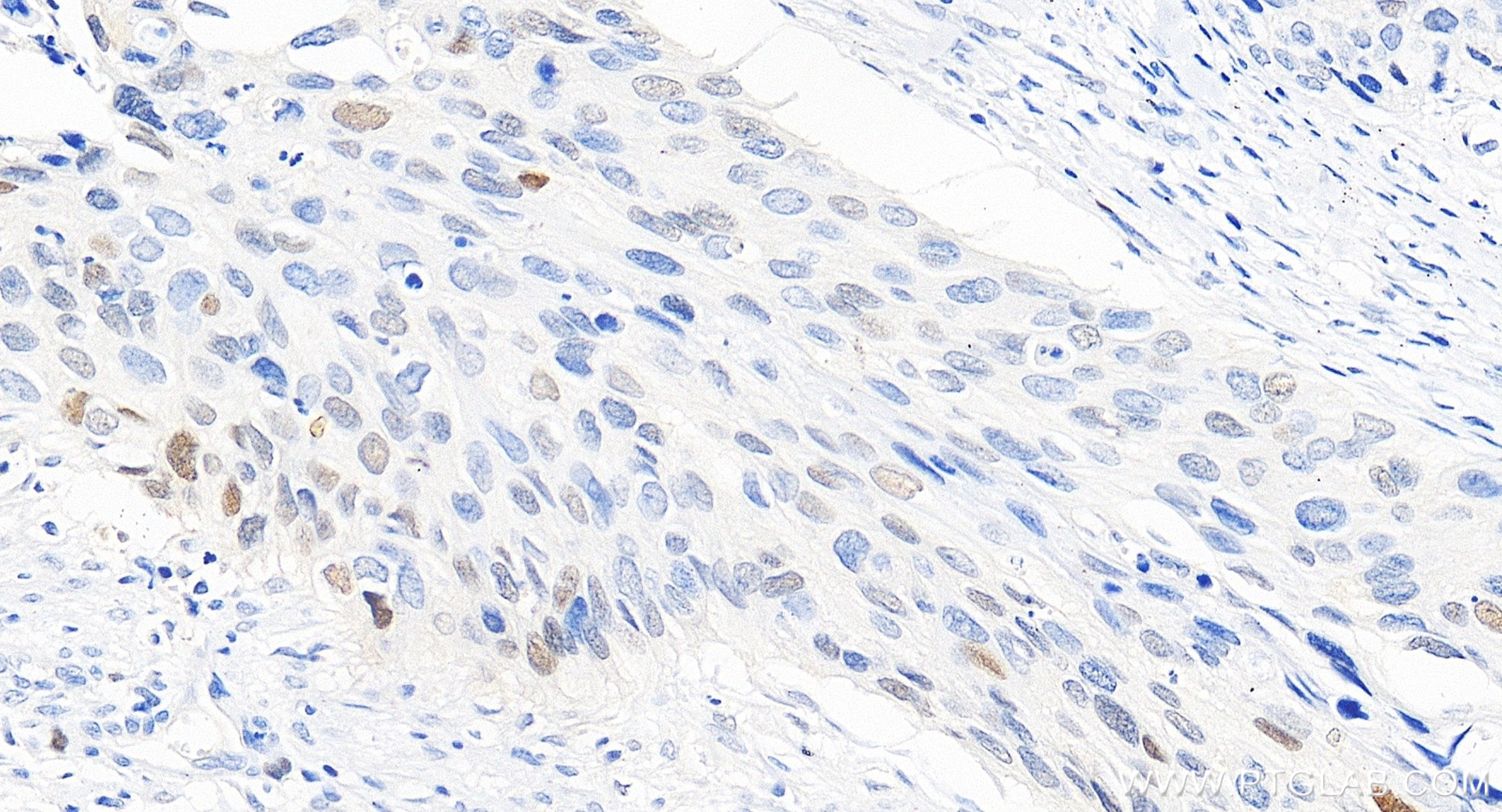 Immunohistochemical analysis of paraffin-embedded human cervical cancer tissue slide using 82669-2-RR (P21 antibody) at dilution of 1:400 (under 20x lens). Heat mediated antigen retrieval with Tris-EDTA buffer (pH 9.0). IHC staining of human cervical cancer using 82669-2-RR