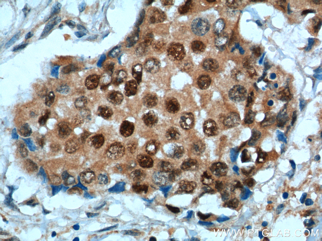 IHC staining of human breast cancer using 25614-1-AP