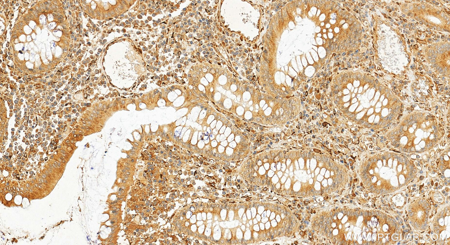 IHC staining of human colon cancer using 12658-1-AP IHC staining of human colon cancer using 12658-1-AP