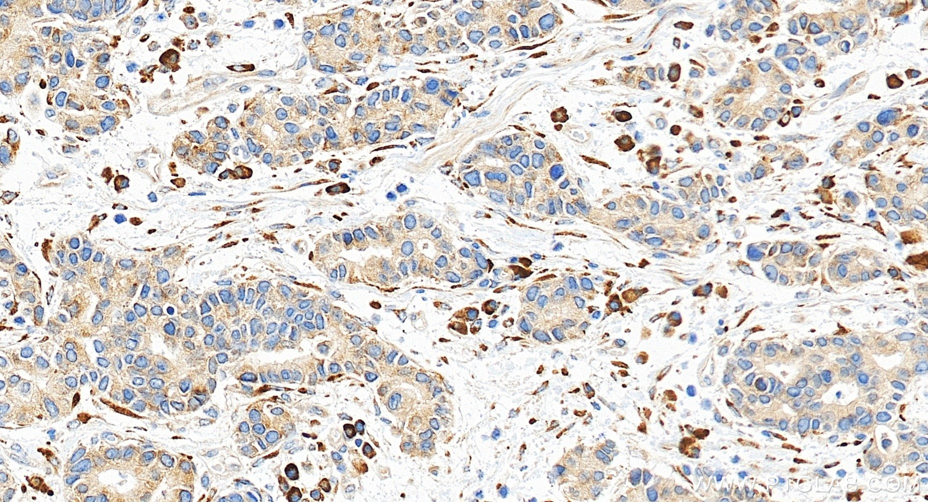 Immunohistochemical analysis of paraffin-embedded human stomach cancer tissue slide using <a class='green' href='/productredirect?CatalogNo=85374-1-RR' target='_blank'>85374-1-RR</a> (P4HA3 antibody) at dilution of 1:1000 (under 20x lens). Heat mediated antigen retrieval with Tris-EDTA buffer (pH 9.0). This data was developed using the same antibody clone with 85374-1-PBS in a different storage buffer formulation. IHC staining of human stomach cancer using 85374-1-RR (same clone as 85374-1-PBS)