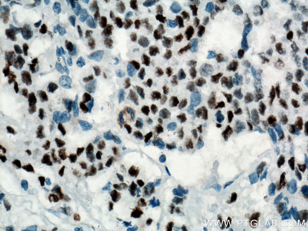 IHC staining of human colon cancer using 60283-2-Ig