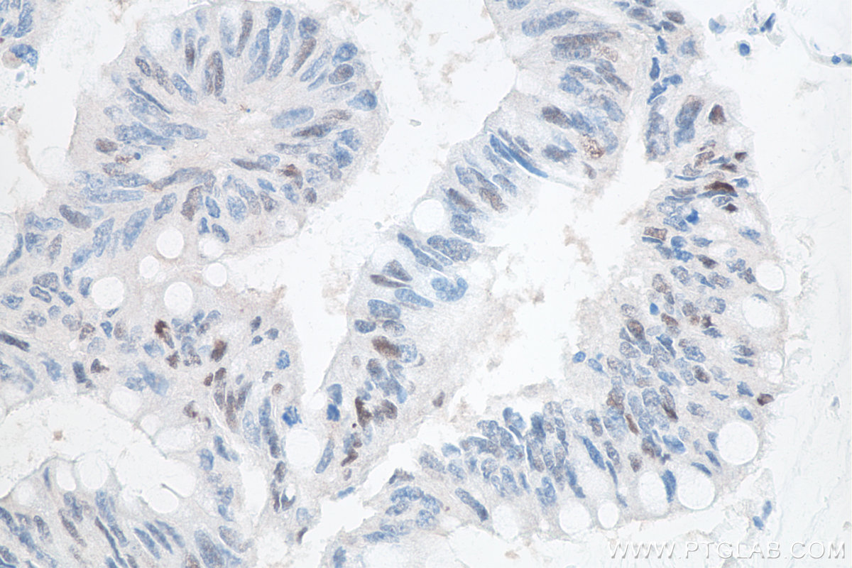 IHC staining of human colon cancer using 60283-2-Ig