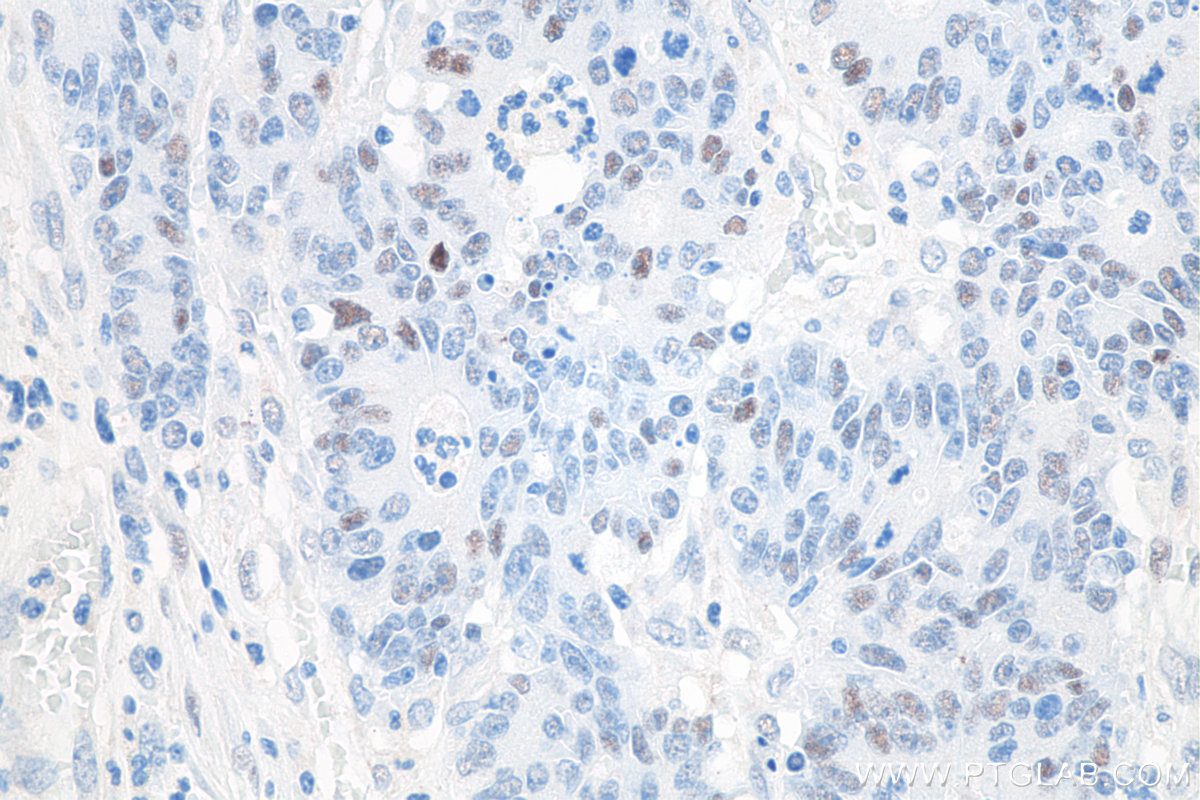 IHC staining of human colon cancer using 60283-2-Ig