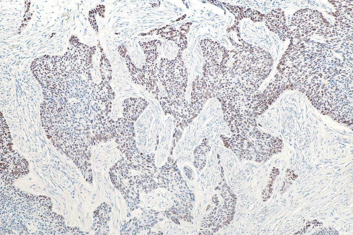 IHC staining of human skin cancer using 60283-2-Ig