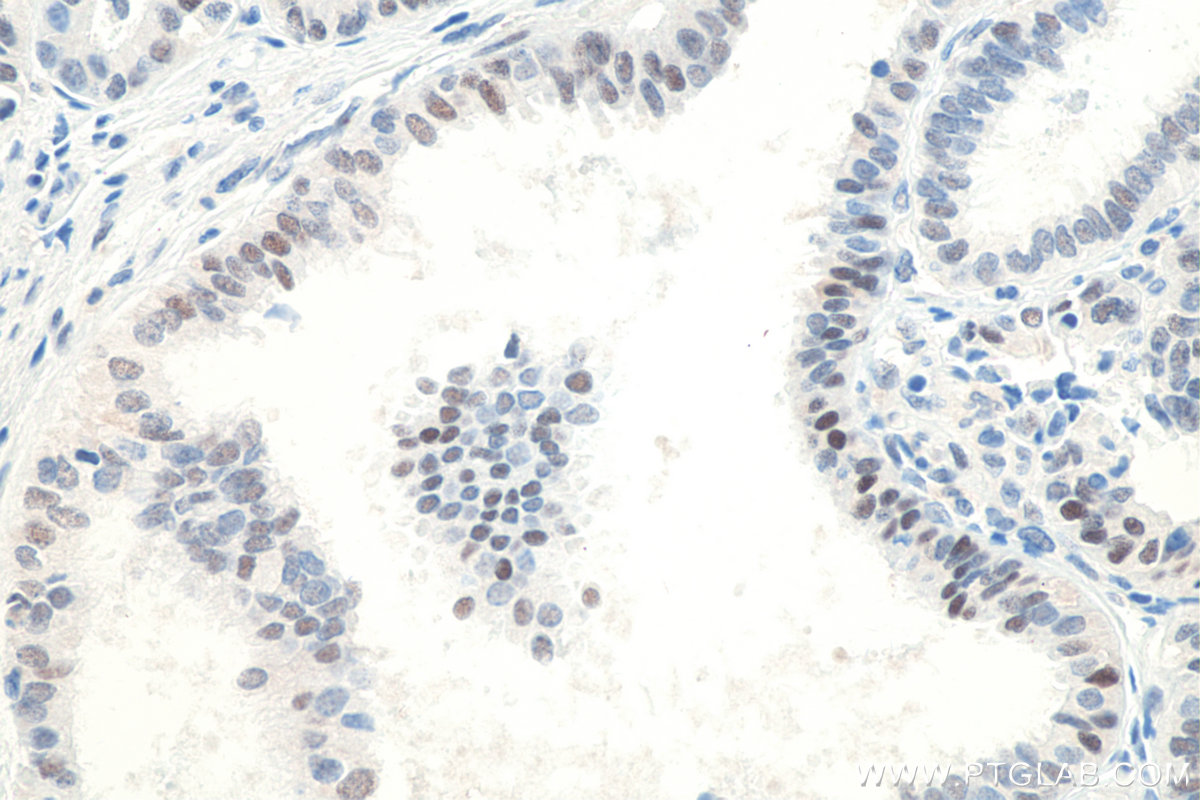 IHC staining of human ovary tumor using 60283-2-Ig