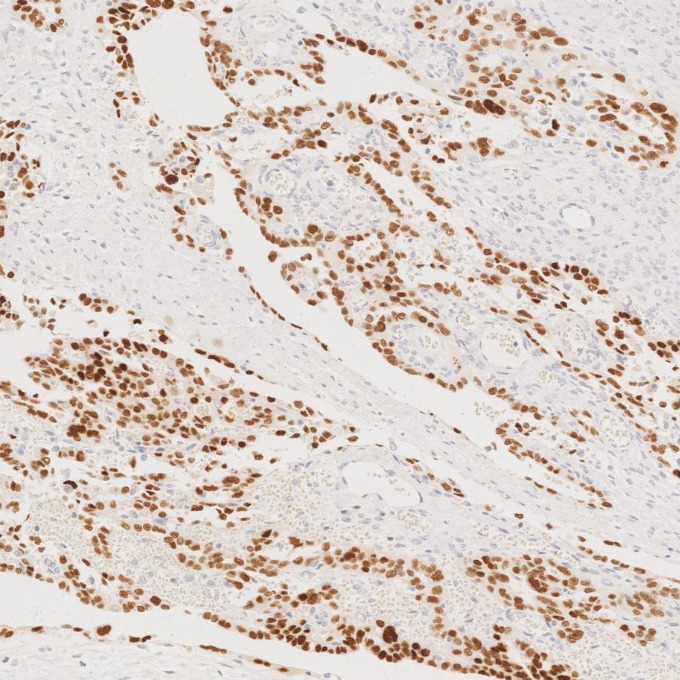 IHC staining of human ovary cancer using 60283-2-Ig