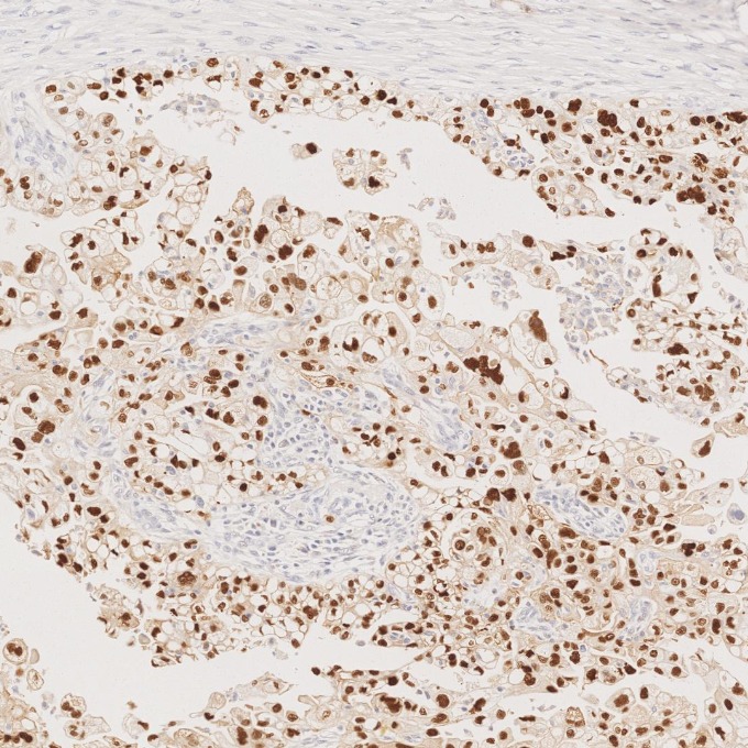 IHC staining of human ovary cancer using 60283-2-Ig