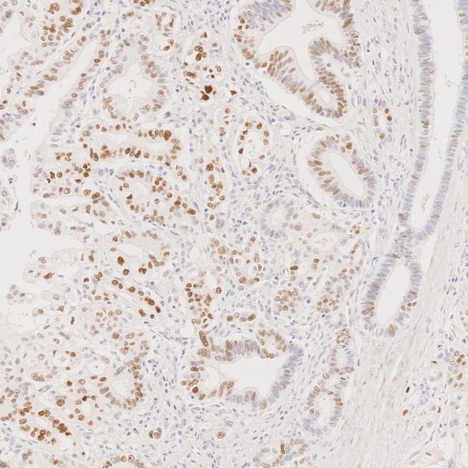 IHC staining of human pancreas cancer using 60283-2-Ig