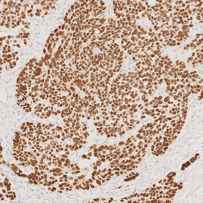 IHC staining of human ovary cancer using 60283-2-Ig